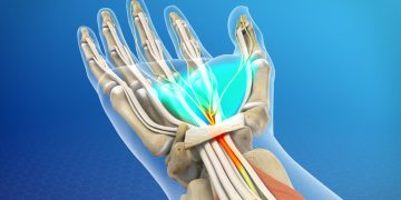 Therapy Found Effective for Carpal Tunnel Syndrome