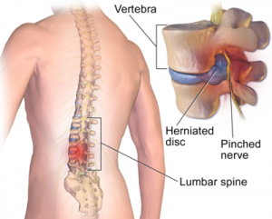 Spinal Disc Decompression treatment